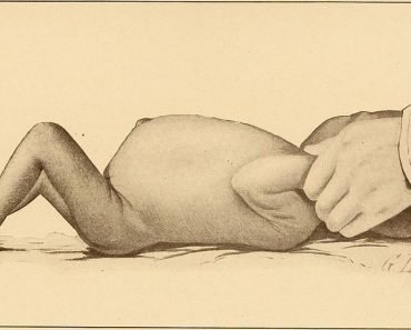Kwashiorkor The diseases of infancy and childhood 370x297 1