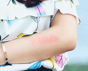 Woman hand on skin allergie 370x297 1