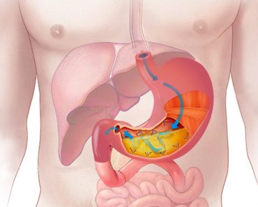 stomach 1 370x297 1