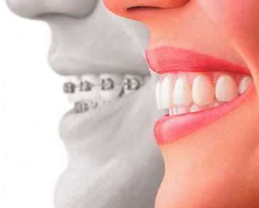 teeth brace 370x297 1