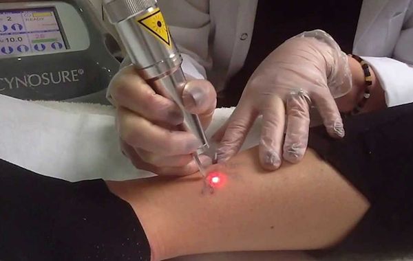 remocao de tatuagem entenda como funciona e quanto custa 2
