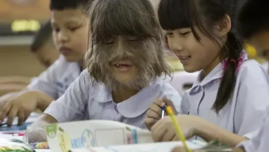 Supatra ‘Natty Sasuphan Worlds hairiest girl
