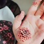 Trypophobia Fear Of Holes