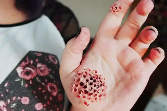Trypophobia Fear Of Holes