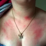 Aquagenic Urticaria water allergy