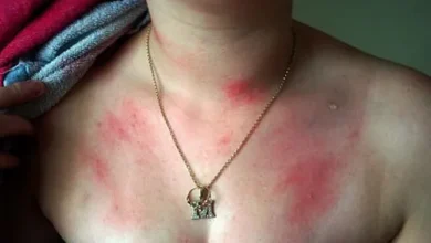 Aquagenic Urticaria water allergy